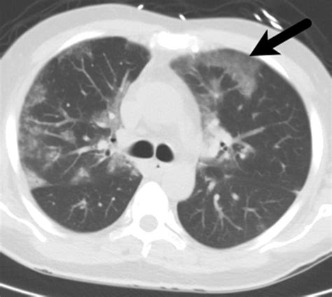 Review of the Chest CT Differential Diagnosis of Ground.